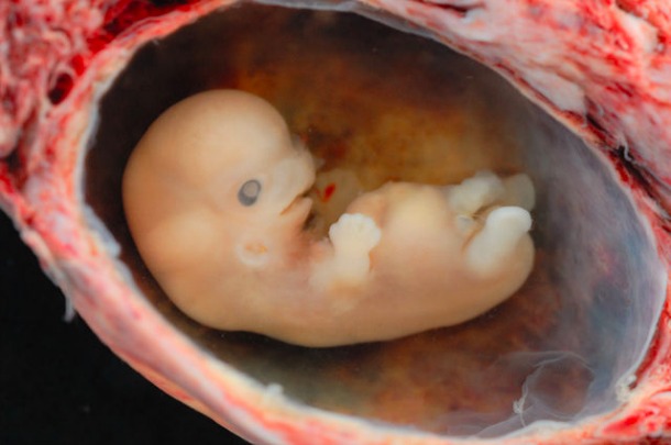 "Human Embryo 8 Weeks" | lunar caustic